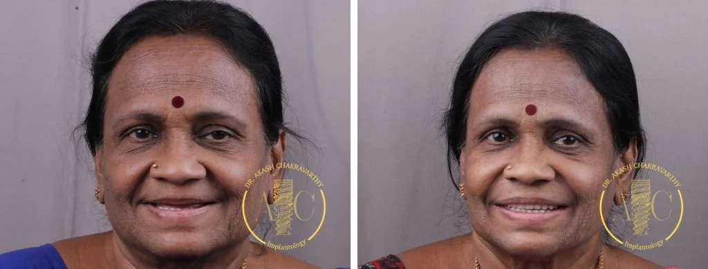 Smile transformation