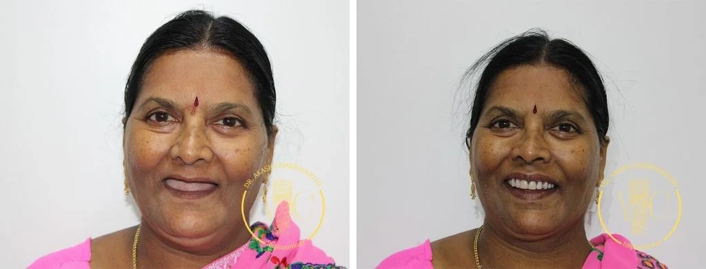 Smile transformation