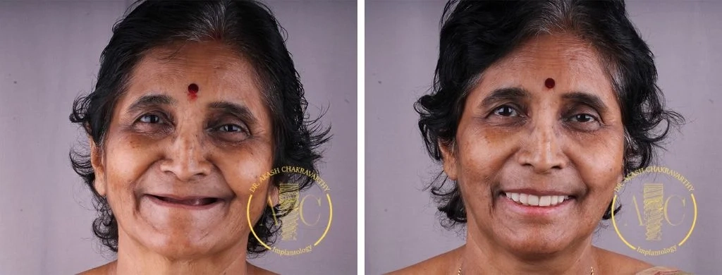 Smile transformation