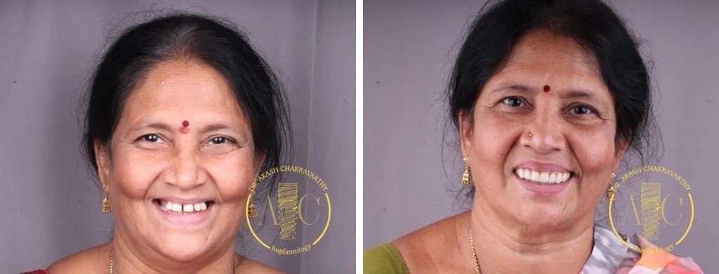 Smile transformation