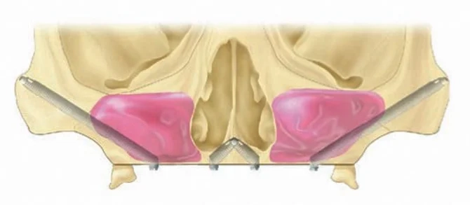 Zygomatic Implants