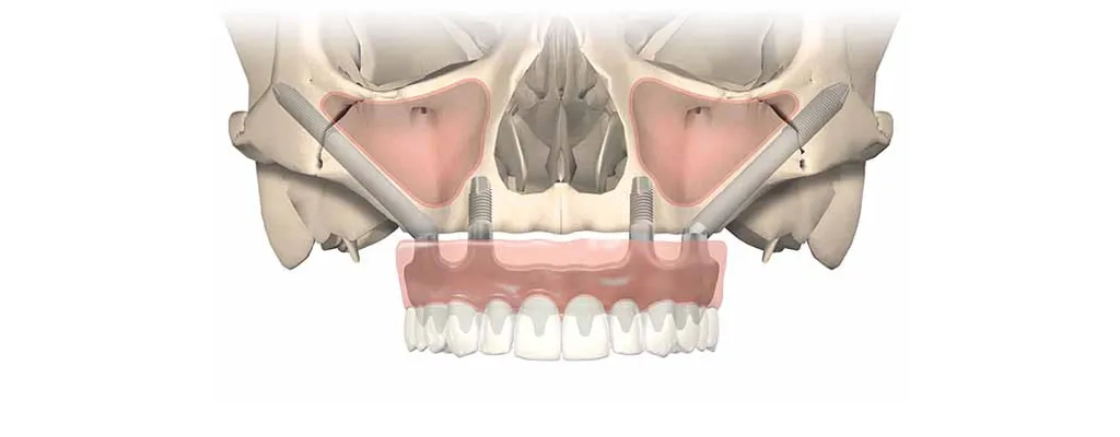 Zygomatic Implants