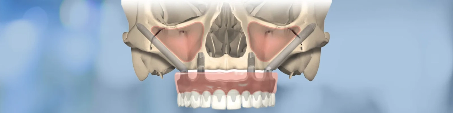 Pterygoid Implants