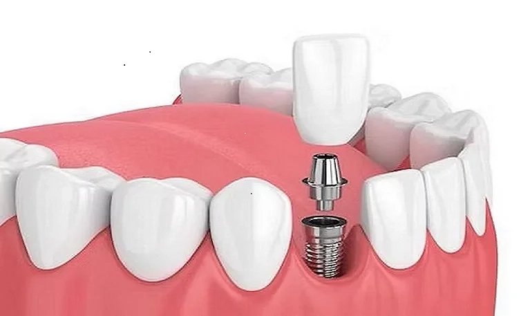 Dental Implants in India: What to Know