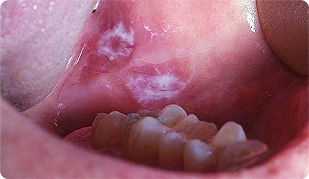 Oral Cancer: Early Warning Signs Every Patient Should Know