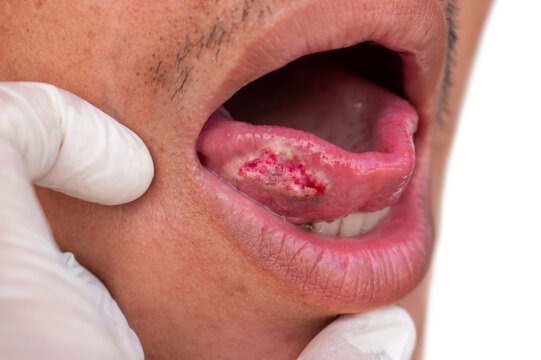 alcohol-and-oral-cancer