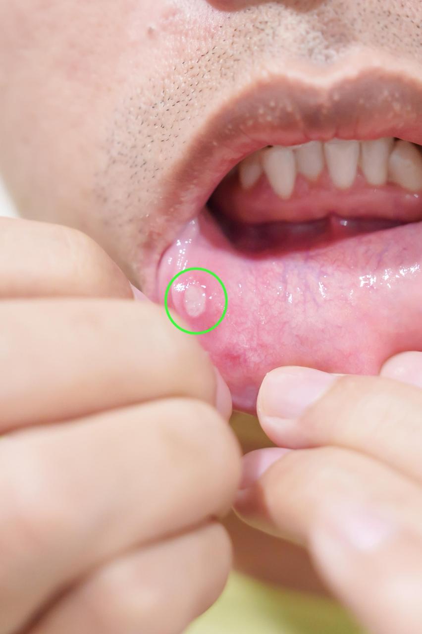 persistent-mouth-ulcer