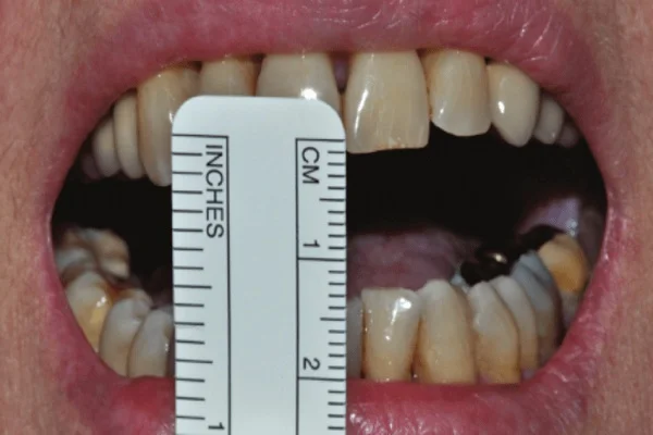 oral-submucous-fibrosis