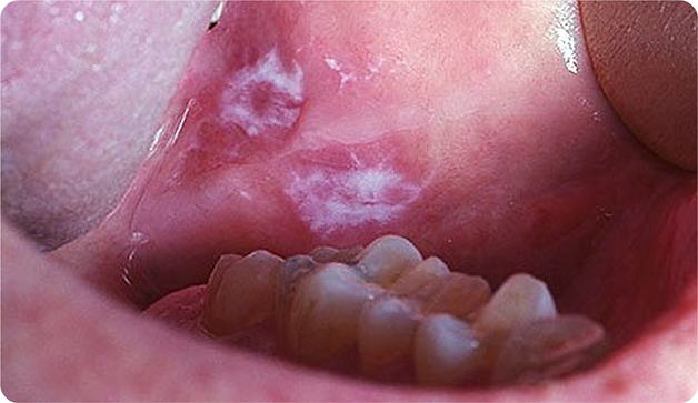 oral-cancer-warning-signs