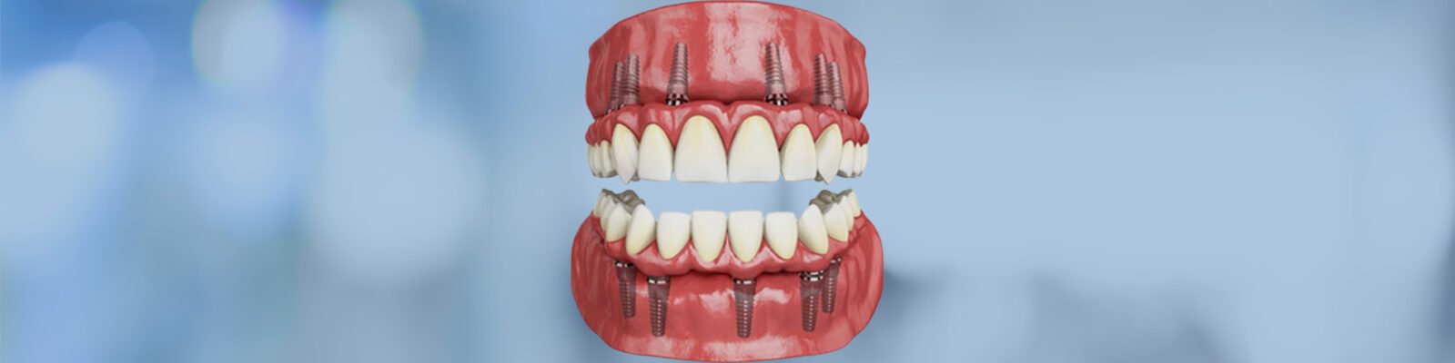 Full Mouth Rehabilitation With Straight Six Implants