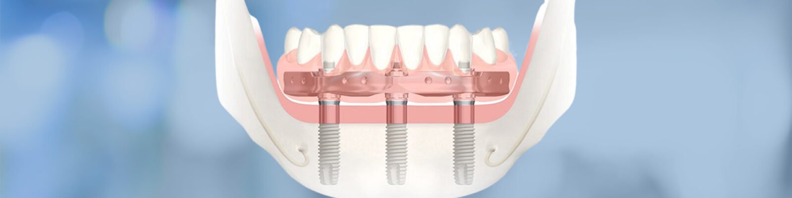 Trefoil Implants